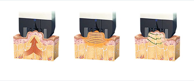 インモードが表皮層|真皮層|SMAS層にHVP技術がどのように作用するかを説明する画像
                                        